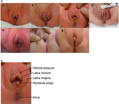 Clitoral preputial edema can be mistaken for clitoromegaly: a clinical analysis of ten cases